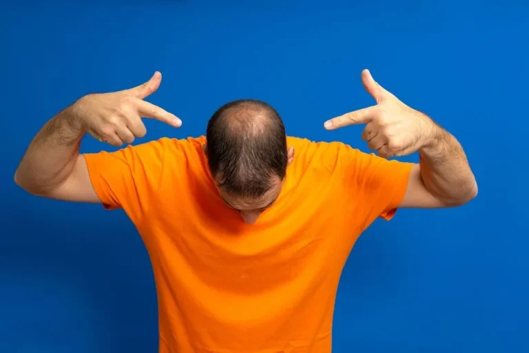 alopecia androgenetica