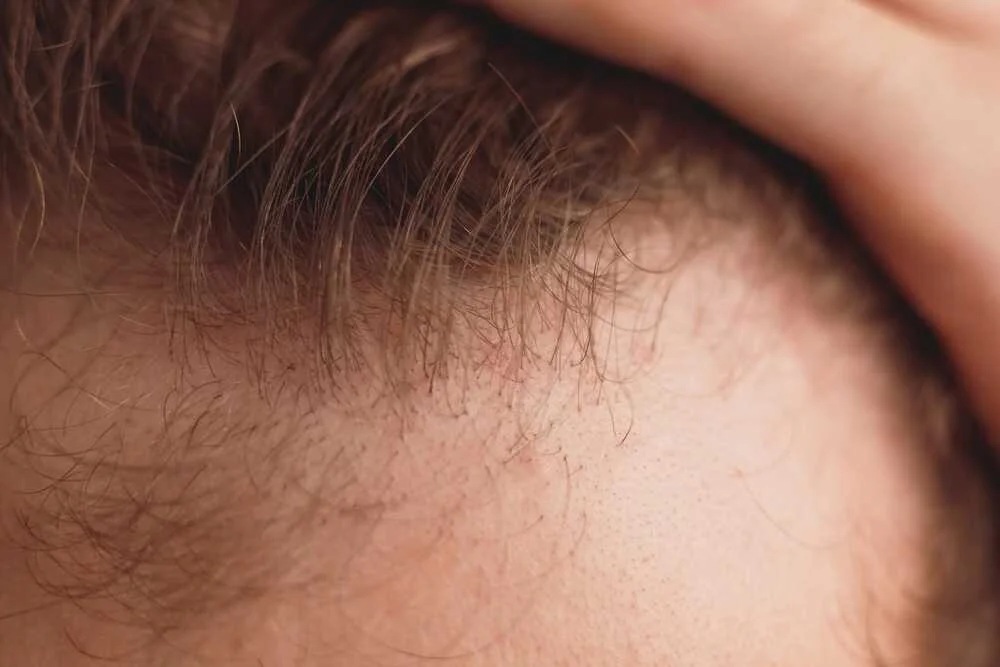 body hair transplant​
