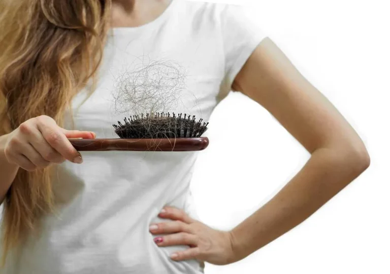 alopecia androgenetica