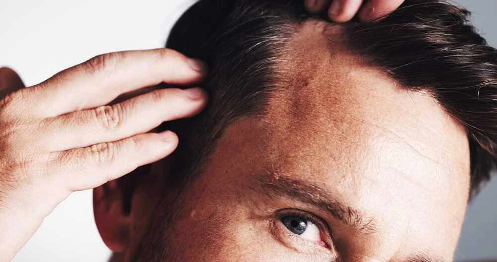 alopecia androgenetica