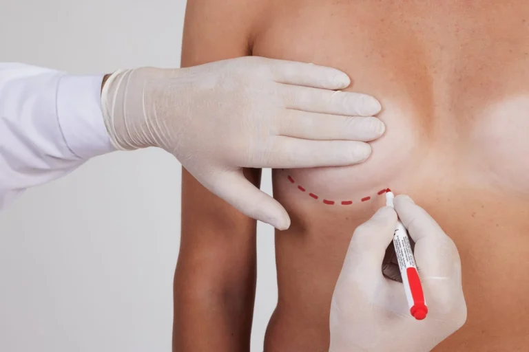 Mastopexy Recovery