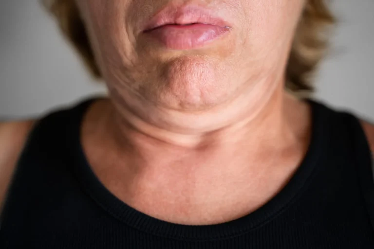 Double Chin Surgery